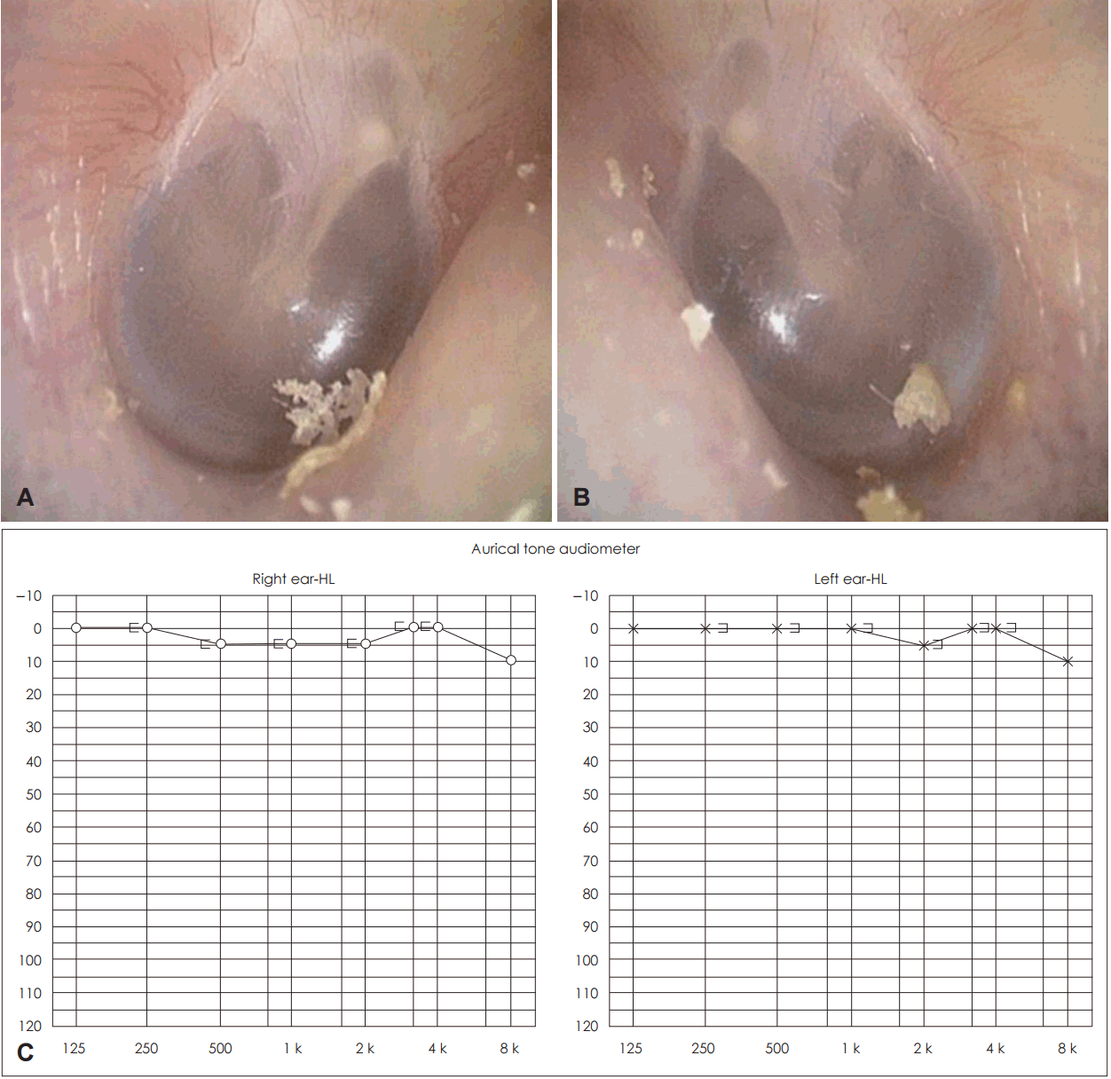 Case report of ?hormonal vertigo, The Journal of Laryngology & Otology