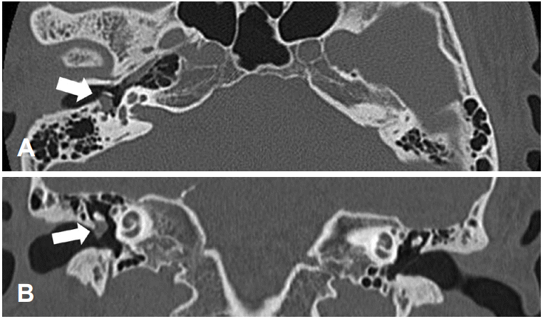 A Case Of Schwannoma Of The Chorda Tympani Nerve